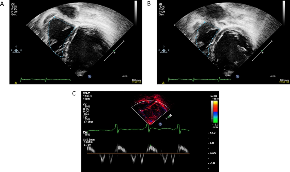 Use of point-of-care ultrasound (POCUS) to monitor neonatal and pediatric extracorporeal life support