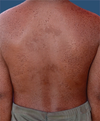 Tinea Imbricata: An Overview