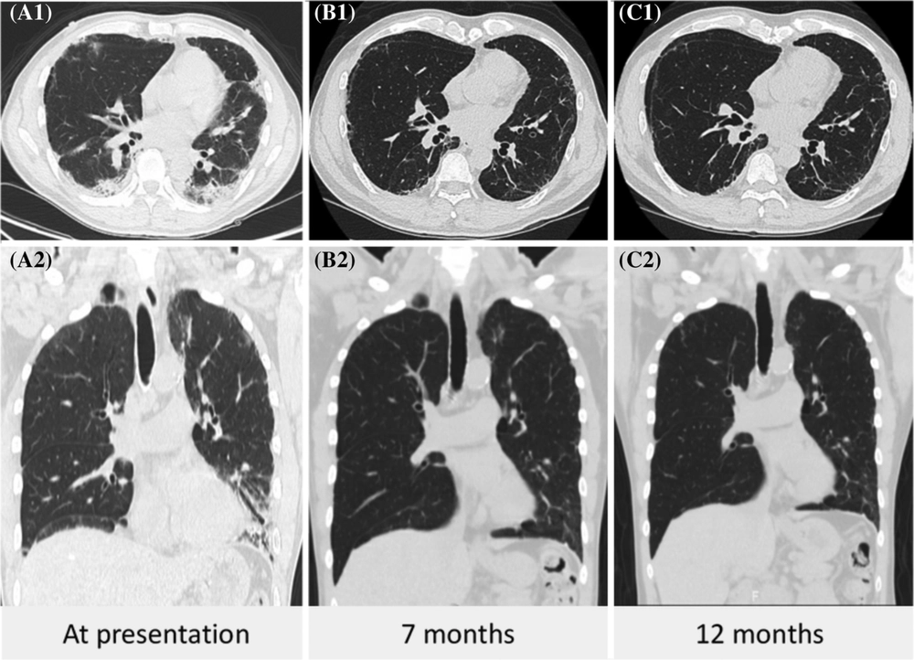 Treatment of electronic cigarette or vaping product use associated l